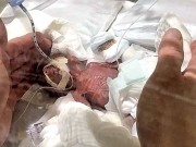 Eζησε το μικρότερο μωρό στον κόσμο