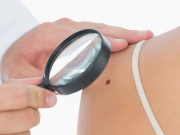 Δωρεάν εξετάσεις για τον καρκίνο του δέρματος